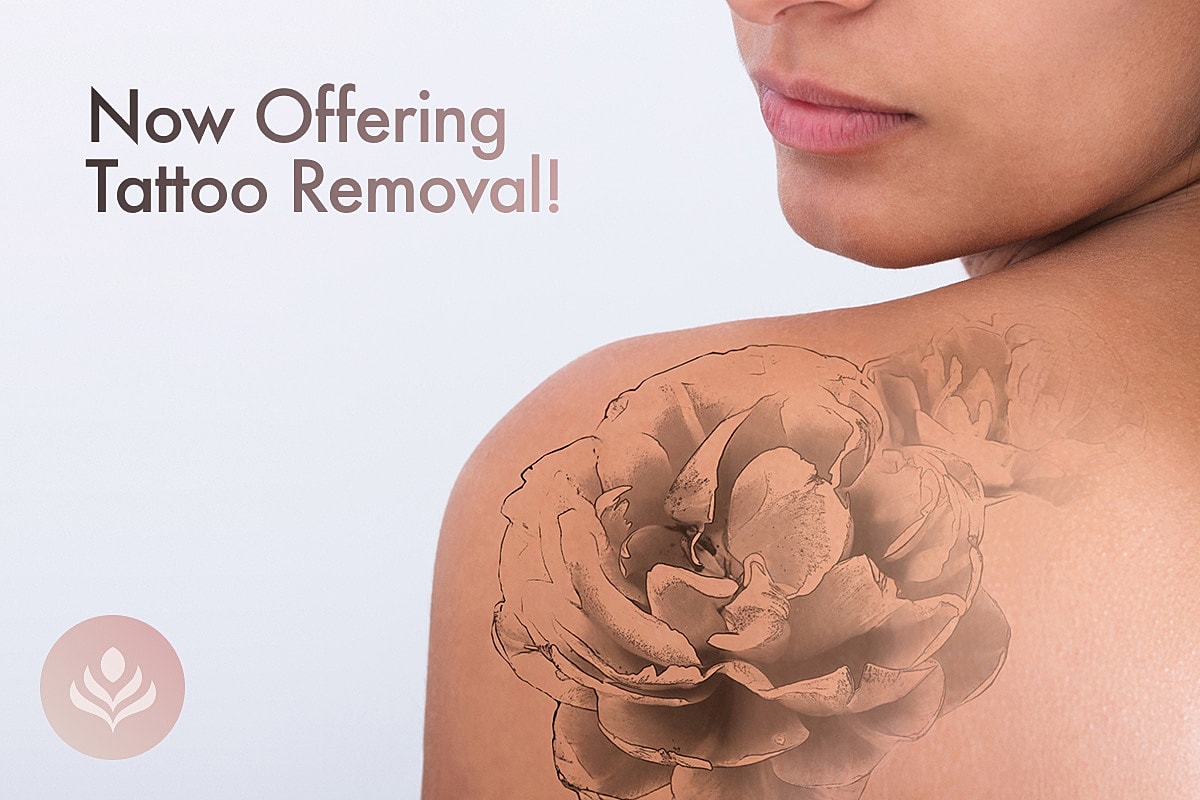 Tattoo removal advertisement featuring a flower design.